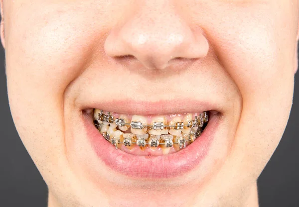 Closeup Mouth Braces — Zdjęcie stockowe