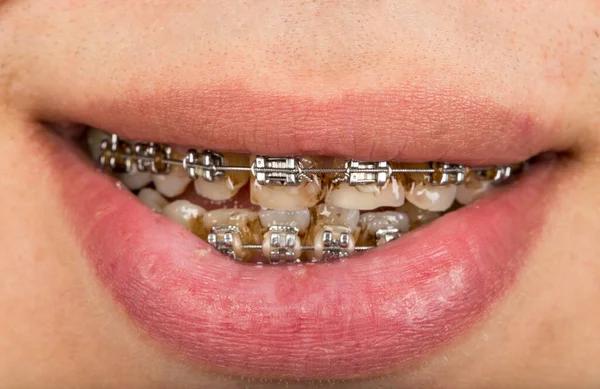 Closeup Mouth Braces — Stok fotoğraf