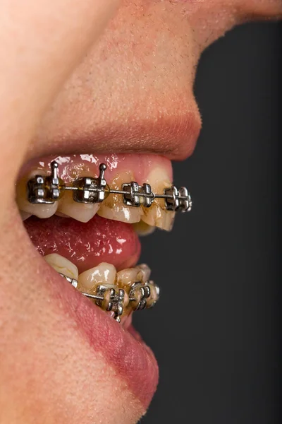 Closeup Mouth Braces — Fotografia de Stock