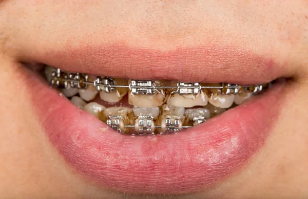 Closeup Mouth Braces — Zdjęcie stockowe