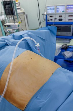 Bariatrik cerrah obeziteyi, yakın çekim ve cerrahi aletleri tedavi etmek için gastrik kol prosedürü uyguluyor..