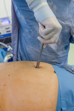 Bariatrik cerrah obeziteyi, yakın çekim ve cerrahi aletleri tedavi etmek için gastrik kol prosedürü uyguluyor..