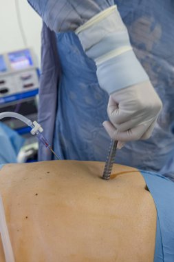 Bariatrik cerrah obeziteyi, yakın çekim ve cerrahi aletleri tedavi etmek için gastrik kol prosedürü uyguluyor..