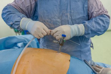 Bariatrik cerrah obeziteyi, yakın çekim ve cerrahi aletleri tedavi etmek için gastrik kol prosedürü uyguluyor..