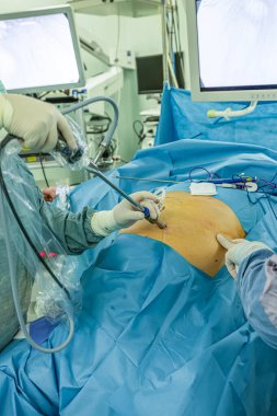Bariatrik cerrah obeziteyi, yakın çekim ve cerrahi aletleri tedavi etmek için gastrik kol prosedürü uyguluyor..