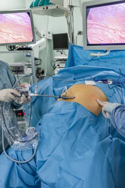 Bariatrik cerrah obeziteyi, yakın çekim ve cerrahi aletleri tedavi etmek için gastrik kol prosedürü uyguluyor..