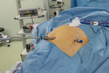 Bariatrik cerrah obeziteyi, yakın çekim ve cerrahi aletleri tedavi etmek için gastrik kol prosedürü uyguluyor..