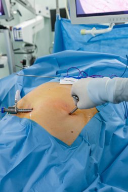 Bariatrik cerrah obeziteyi, yakın çekim ve cerrahi aletleri tedavi etmek için gastrik kol prosedürü uyguluyor..