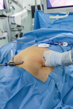 Bariatrik cerrah obeziteyi, yakın çekim ve cerrahi aletleri tedavi etmek için gastrik kol prosedürü uyguluyor..