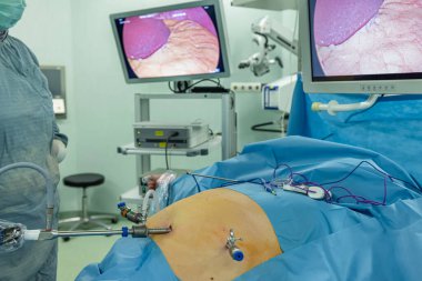 Bariatrik cerrah obeziteyi, yakın çekim ve cerrahi aletleri tedavi etmek için gastrik kol prosedürü uyguluyor..