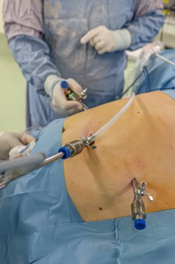 Bariatrik cerrah obeziteyi, yakın çekim ve cerrahi aletleri tedavi etmek için gastrik kol prosedürü uyguluyor..