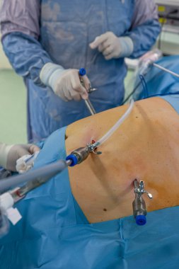 Bariatrik cerrah obeziteyi, yakın çekim ve cerrahi aletleri tedavi etmek için gastrik kol prosedürü uyguluyor..