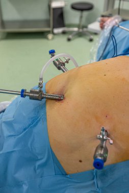 Bariatrik cerrah obeziteyi, yakın çekim ve cerrahi aletleri tedavi etmek için gastrik kol prosedürü uyguluyor..