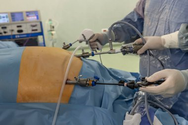 Bariatrik cerrah obeziteyi, yakın çekim ve cerrahi aletleri tedavi etmek için gastrik kol prosedürü uyguluyor..