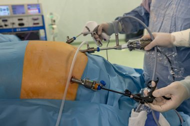 Bariatrik cerrah obeziteyi, yakın çekim ve cerrahi aletleri tedavi etmek için gastrik kol prosedürü uyguluyor..