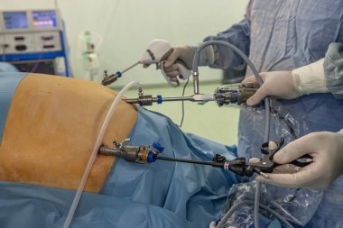 Bariatrik cerrah obeziteyi, yakın çekim ve cerrahi aletleri tedavi etmek için gastrik kol prosedürü uyguluyor..