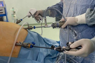 Bariatrik cerrah obeziteyi, yakın çekim ve cerrahi aletleri tedavi etmek için gastrik kol prosedürü uyguluyor..