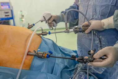 Bariatrik cerrah obeziteyi, yakın çekim ve cerrahi aletleri tedavi etmek için gastrik kol prosedürü uyguluyor..