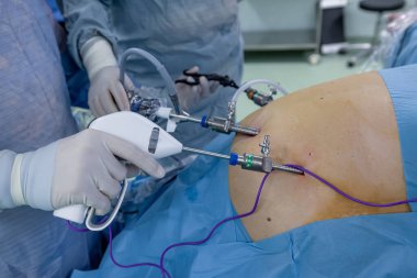 Bariatrik cerrah obeziteyi, yakın çekim ve cerrahi aletleri tedavi etmek için gastrik kol prosedürü uyguluyor..