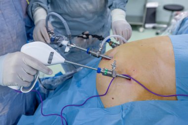 Bariatrik cerrah obeziteyi, yakın çekim ve cerrahi aletleri tedavi etmek için gastrik kol prosedürü uyguluyor..