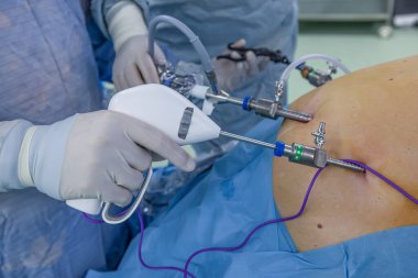 Bariatrik cerrah obeziteyi, yakın çekim ve cerrahi aletleri tedavi etmek için gastrik kol prosedürü uyguluyor..