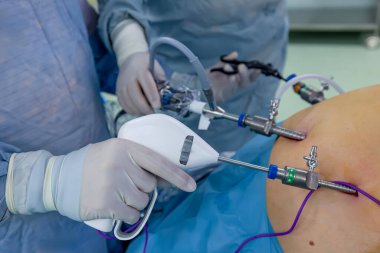 Bariatrik cerrah obeziteyi, yakın çekim ve cerrahi aletleri tedavi etmek için gastrik kol prosedürü uyguluyor..