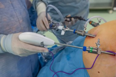 Bariatrik cerrah obeziteyi, yakın çekim ve cerrahi aletleri tedavi etmek için gastrik kol prosedürü uyguluyor..