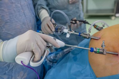 Bariatrik cerrah obeziteyi, yakın çekim ve cerrahi aletleri tedavi etmek için gastrik kol prosedürü uyguluyor..