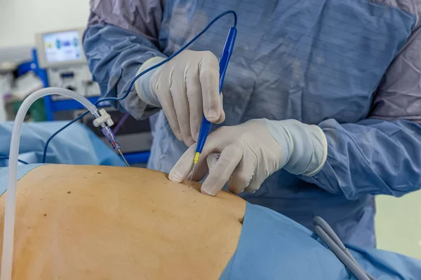 Bariatrik cerrah obeziteyi, yakın çekim ve cerrahi aletleri tedavi etmek için gastrik kol prosedürü uyguluyor..