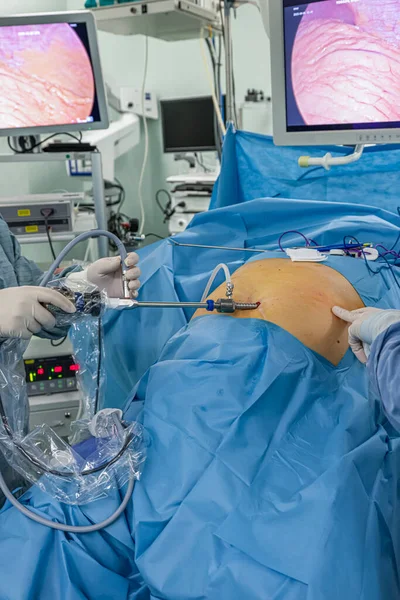 Bariatrik cerrah obeziteyi, yakın çekim ve cerrahi aletleri tedavi etmek için gastrik kol prosedürü uyguluyor..