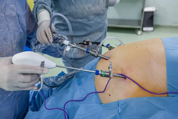 Bariatrik cerrah obeziteyi, yakın çekim ve cerrahi aletleri tedavi etmek için gastrik kol prosedürü uyguluyor..