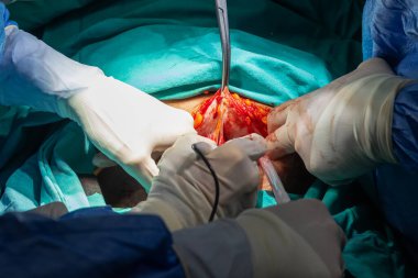 Ameliyathanede sezaryenle doğum. Hastanede yeni doğmuş bir bebek, ameliyat masası. Yeni bir hayat, sezaryen yoluyla doğan bebek ameliyathanede..