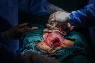 Cerrahlar ameliyathanede sezaryen yapıyor. Cerrahi ekip ameliyat yapıyor. Doktor sterilize ekipman kullanarak ameliyat yapıyor. Jinekologlar ve ebeler doğum yapıyor..