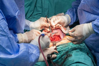 Cerrahlar ameliyathanede sezaryen yapıyor. Cerrahi ekip ameliyat yapıyor. Doktor sterilize ekipman kullanarak ameliyat yapıyor. Jinekologlar ve ebeler doğum yapıyor..