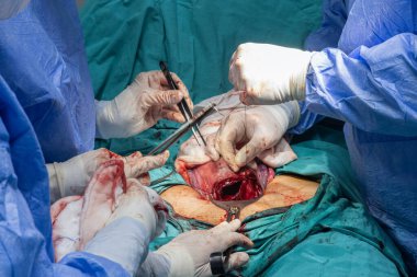 Cerrahlar ameliyathanede sezaryen yapıyor. Cerrahi ekip ameliyat yapıyor. Doktor sterilize ekipman kullanarak ameliyat yapıyor. Jinekologlar ve ebeler doğum yapıyor..