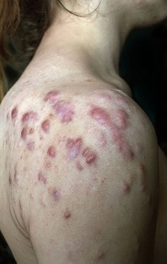 Genç bir kızın omzunda iri keloidler. Keloid büyümeleri. Bir sürü kızıl keloit. Gençlerde sivilcelerin tedavisi ve sorunları. Deri döküntüleri. Deride sorun var..