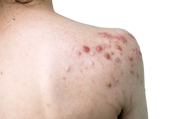 Keloide Und Narben Rücken Nach Der Behandlung Von Akne Problemen — Stockfoto