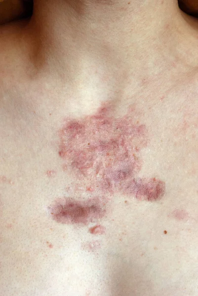 少女の乳房にあるケロイドと肥大性の傷跡正面図 閉めろ 若い人たちのにきびの問題と治療 皮膚の発疹 皮膚の問題 — ストック写真