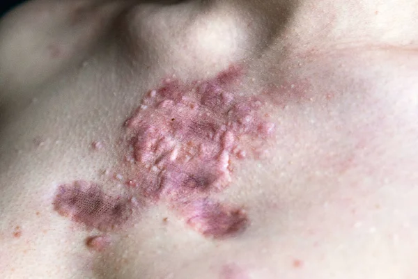 Scar Keloid Hypertrophic Occurring Female Breast Problems Treatment Acne Young — Φωτογραφία Αρχείου