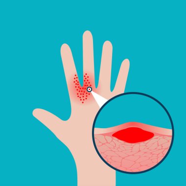 Egzama dermatoloji kavramı