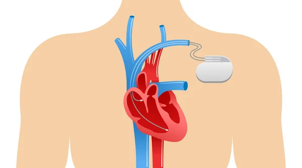 Anatomické schéma kardiostimulátoru — Stockový vektor