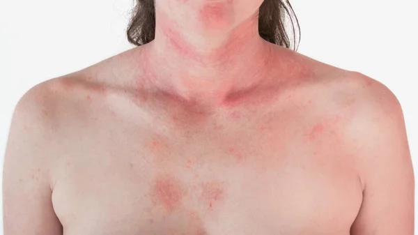 Allergic Skin Reaction Female Neck Face Red Rash — Stock Photo, Image