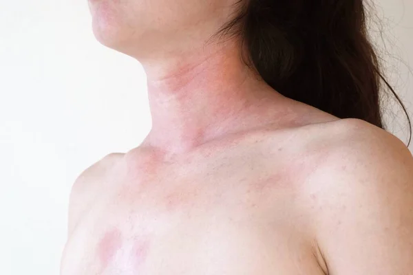 Réaction Cutanée Allergique Cou Poitrine Femme — Photo