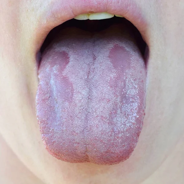 Oral Candidiasis Eller Oral Trush Candida Albicans Svampinfektion Tungan Närbild — Stockfoto
