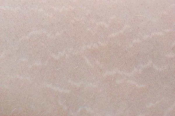 Strie Fotografia Dettagliata Smagliature Sulla Pelle Umana Problema Cosmetico Dermatologico — Foto Stock