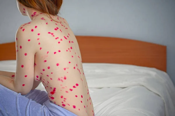 Herpes Las Mujeres Grave Estado Salud Varicela Adultos Espinillas Untadas — Foto de Stock