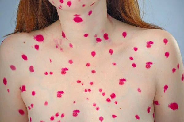 Herpes Women Serious State Health Chickenpox Adults Pimples Anointed Medicinal — Stock Photo, Image