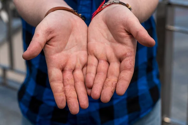 Dishidrotik egzama, hastanın elleri. Sağlık hizmeti kavramı