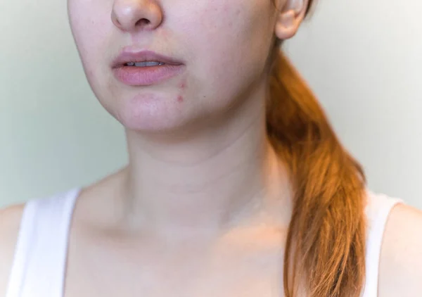 Problemhaut Die Hautausschlägen Und Akne Neigt Akne Narben Konzept Der — Stockfoto