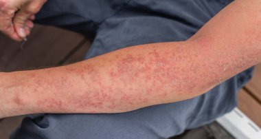 Dishidrotik otoimmün hasta egzaması. Sağlık hizmeti kavramı